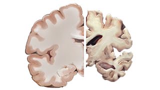 Alzheimers and the Brain [upl. by Odelle472]