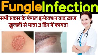 Fungle infection  Fungle infection treatment symptoms  precaution [upl. by Eelloh]