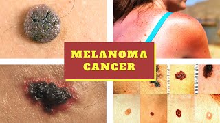 Melanoma Symptoms  Causes Pictures Stages Signs and Symptoms of Melanoma Skin Cancer Tumor [upl. by Yrral990]