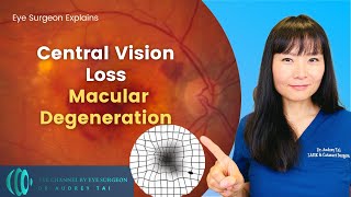 Macular Degeneration Everything You Need to Know  Eye Surgeon Explains draudreytai [upl. by Volkan707]