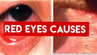 RED EYE  CAUSES  Conjunctivitis Vs Uveitis vs Acute angle closure Glaucoma [upl. by Hailey]