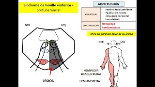 HEMIPLEJÍAS ALTERAS TRONCALES SINDROMES ALTERNOS [upl. by Hseyaj]