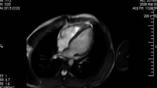 Cardiología HU  Resonancia Magnética Cardiaca Normal [upl. by Gustave917]