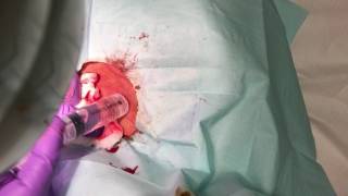 GRAPHIC HOLY JUMPING CAPSULE Epidermoid CYST [upl. by Eilyk]