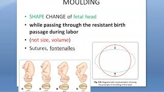 Obstetrics 119 Moulding Fetal head skull adjust supermoulding degree Shape SubDural SubArachnoid CPD [upl. by Rye]