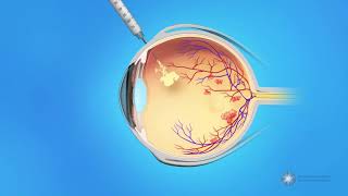 Eye Injections for Central Retinal Vein Occlusion CRVO [upl. by Glyn766]