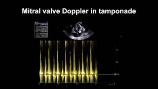 Echocardiography Essentials Detecting pericardial effusions [upl. by Yelkcub120]