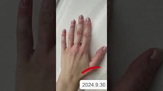 Vitiligo on Hands  Best treatment for vitiligo  Vitiligo Specialist [upl. by Kleinstein]