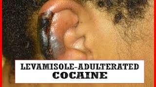 Levamisole Adulterated Cocaine Vasculitis Part II [upl. by Bradshaw768]