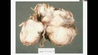 HistopathologyBrain Meningioma [upl. by Glad]