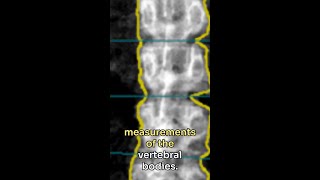 Opportunistic Bone Mineral Density Measurement Using PCD CT Spectral Localizer Images [upl. by Avihs]