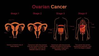 Stages of Ovarian Cancer [upl. by Cacilia]