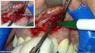 Dr Korkut Aldemir  Maxillary Odontogenic Radicular Cyst [upl. by Beitz970]