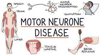 Understanding Motor Neurone Disease Amyotrophic Lateral Sclerosis [upl. by Anesor]