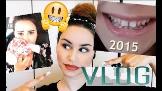 DENTI E APPARECCHIO VLOG DAL 2015 AD OGGI [upl. by Guendolen944]