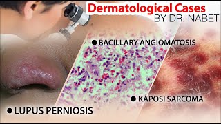 Bacillary angiomatosis  Kaposi sarcoma  Lupus perniosis [upl. by Aicatsan]