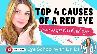 How To Get Rid Of Red Eyes  Top 4 Causes Of A Red Eye  An Optometrist Dishes all the Dirt [upl. by Adnilasor]