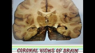 Brain Anatomy Neuroanatomy  Coronal Sectional Views [upl. by Elicia739]