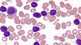 Chronic Lymphocytic Leukemia CLL [upl. by Maximilien476]