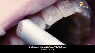 Bracket removal with LiteTouch™ ErYAG laser [upl. by Enelloc628]