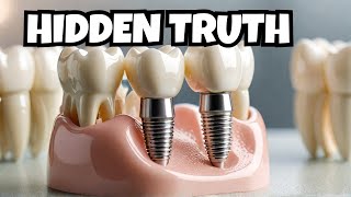 Dental Implants What they dont tell you [upl. by Ieso279]