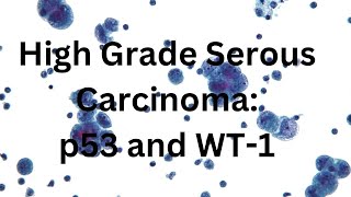 WT1 and p53 High Grade Ovarian Serous Carcinoma [upl. by Jarl511]