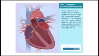 PSVT Paroxysmal Supraventricular Tachycardia Animation Video [upl. by Anavlys]