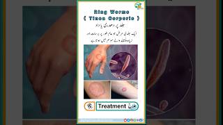 Ring Worms  Tinea Corporis Disease Symptoms and Treatment in UrduHindi medicine shortvideo [upl. by Donelson272]