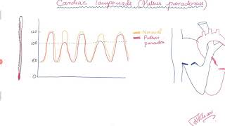 Cardiac Tamponade and Pulsus paradoxus [upl. by Vinay543]