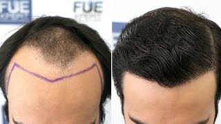 FUE Hair Transplant 3000 Grafts NW III progressing to V by Dr Juan Couto  FUEXPERT CLINIC Spain [upl. by Tenn]