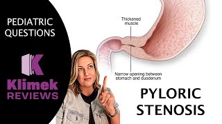 PYLORIC STENOSIS  questions with Dr Sharon [upl. by Ardnajela]