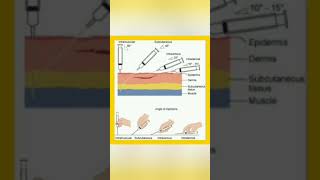 Route  technique of injection administration 💉knowledge easylearning shortsvideo shayari [upl. by Eillo]