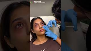 Dermis Clinic  Dark Circles pigmention darkeyes skincareroutine skincare manchester [upl. by Icart216]