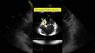 Tricuspid Valve Atresia  Echocardiography For Beginners echocardiogram shorts [upl. by Nanah]