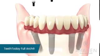 Prótesis fija sobre implantes  Abaden Dentistas [upl. by Schweiker965]