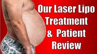 Lipo Laser ilipo Treatment amp Review From a Patient [upl. by Sidman423]