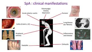 Nouveautés dans les Spondylarthrites [upl. by Leisha]