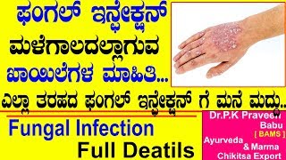 Skin Fungal Infections Symptoms Causes Treatments  Ayurveda tips in Kannada  DrPraveen Babu [upl. by Dix646]