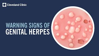 5 Warning Signs of Genital Herpes [upl. by Kciredohr]