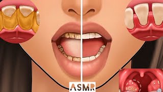 ASMR Get Rid of Bad Breath Tonsil Stone Removal Salivary Glands Cleaning ASMR [upl. by Ardnalak640]