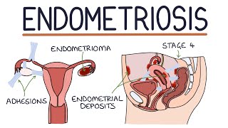 Understanding Endometriosis [upl. by Clarine]