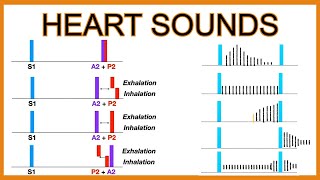 Heart Murmur Example 1 Explained [upl. by Rosmarin844]