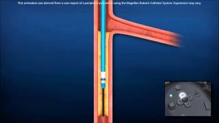 Lower Extremity PAD Treatment with Robotics [upl. by Otrebmal609]