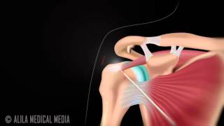 Arthroscopic Subacromial Decompression [upl. by Assirehs]