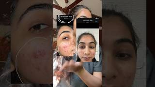 Glow skin product reveal💯emolene moisturizer anishaarora glowskin pimpleproblem [upl. by Macintosh685]