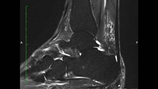 MRI ankle Split Peroneus Brevis Tear [upl. by Noyk21]