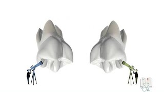 Differences between Maxillary 1st amp 2nd Molar [upl. by Macintyre]