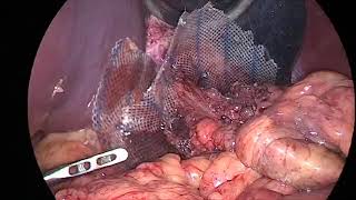 Laparoscopic repair of giant hiatus hernia with composite mesh [upl. by Dickerson]