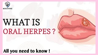 Herpes Oral  causes symptoms treatment pathology  Herpes simplex virus [upl. by Lynsey624]