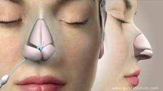 Rhinoplasty Nose Job Video Animation  Guncel Ozturk MD  DRGO [upl. by Anselme]